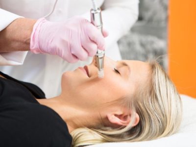 Microneedling